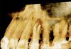 Diagnostic des caries sous une prothèse fixe avec l’imagerie Cone Beam