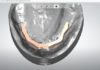 3Shape Dental System : conception 3D des barres sur implants